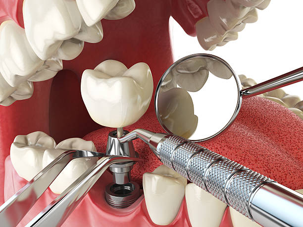 Best Emergency Tooth Extraction in Tahlequah, OK